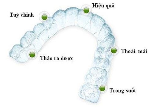 Niềng răng không mắc cài