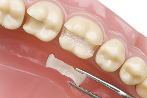 Thời gian trám răng thưa còn phụ thuộc vào tình trạng răng miệng của bệnh nhân 