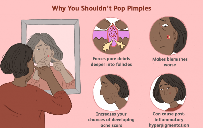 What Age Does Teenage Acne Stop For Guys? What Age Does Teenage Acne Stop For Guys?