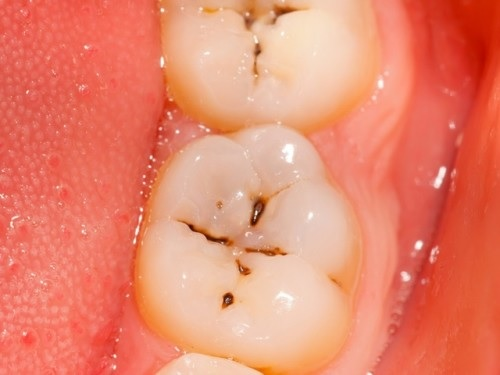 Nguyên nhân gây ra hiện tượng sâu răng 