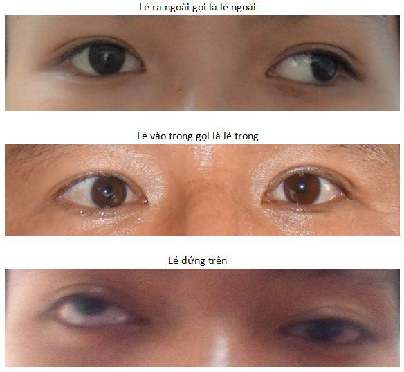 Phân loại mắt theo tình trạng mắt