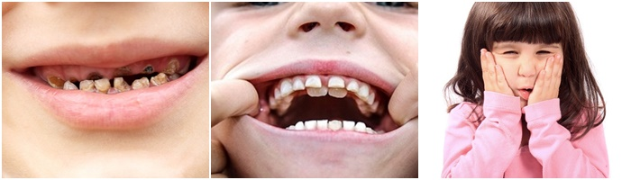 Những biến chứng khi nhổ răng cửa cho bé