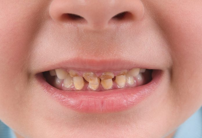 Răng trẻ bị xỉn màu