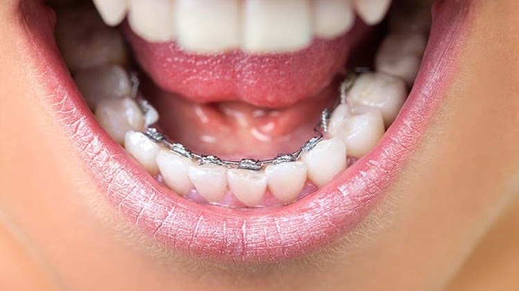 Niềng răng mắc cài trong giúp đảm bảo tính thẩm mỹ