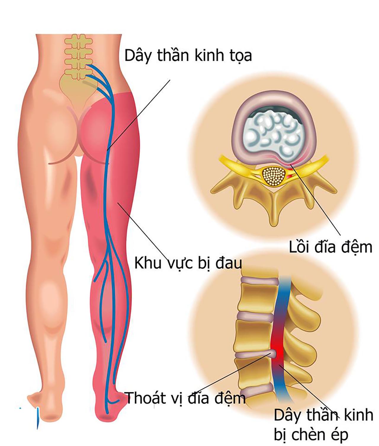 Đau thần kinh tọa kéo dài bao lâu và làm thế nào để giảm triệu chứng