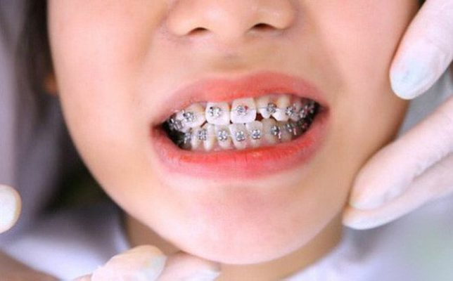 Mắc cài kim loại truyền thống