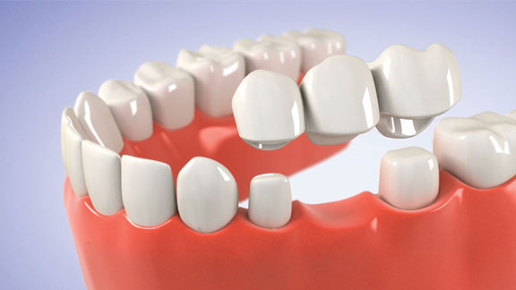 Phương pháp trồng răng cửa cố định (trồng răng sứ)
