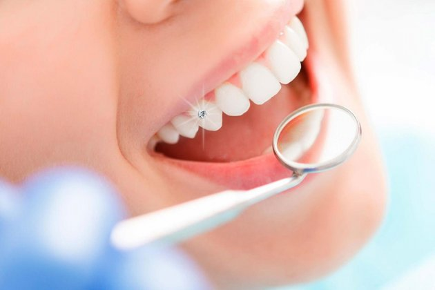 Khử trùng và sạch đá gắn răng thường xuyên 