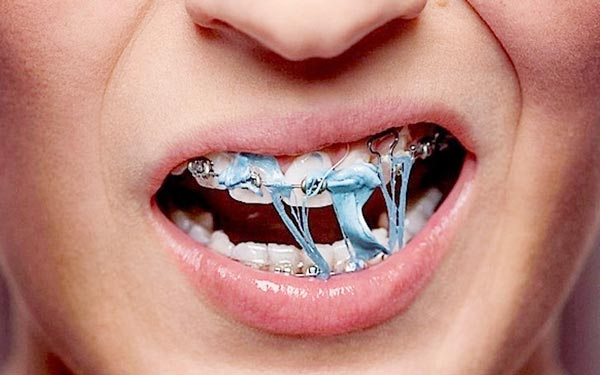 Không nên ăn đồ quá cứng, dai hoặc dính