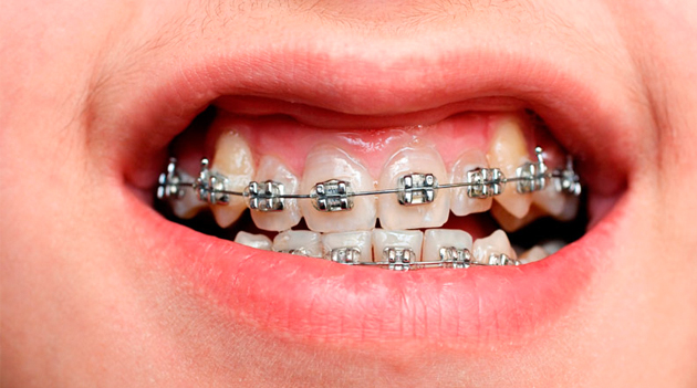 Tùy thuộc vào tình trạng răng miệng mỗi người mà thời gian rút ngắn hay dài