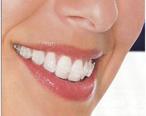 Niềng răng mắc cài trong suốt 