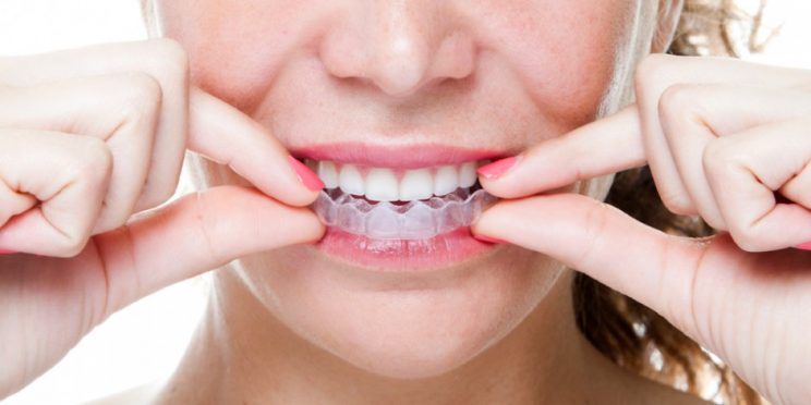 Đeo máng tẩy trắng răng