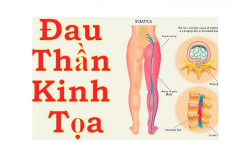 Cách ngâm chân chữa đau thần kinh tọa