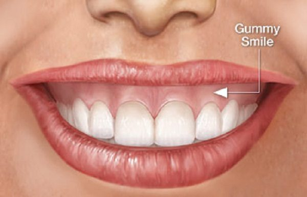 Cười hở lợi gây mất thẩm mỹ