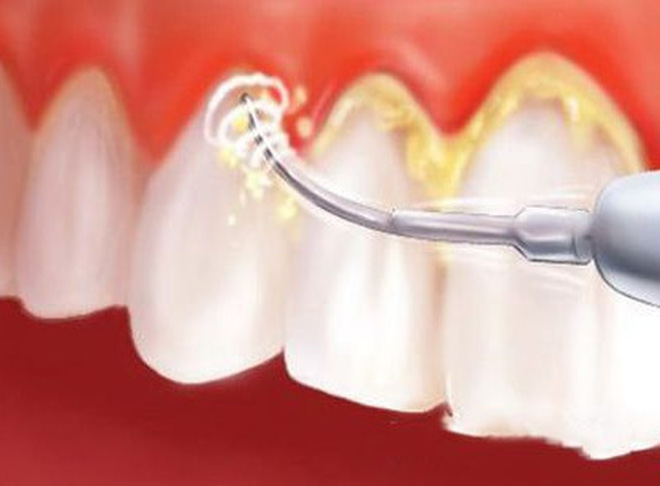 Những mảng bám lâu ngày gây mất thẩm mỹ