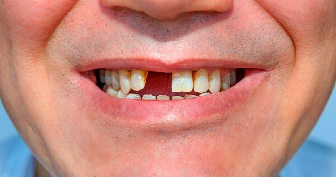 Lý do nên trồng răng cửa