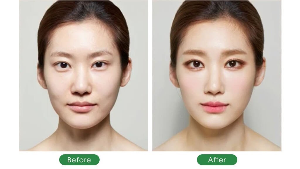 Nguyên nhân của má hóp là gì?