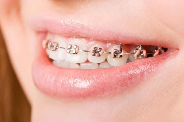 Loại mắc cài cũng ảnh hưởng thời gian niềng