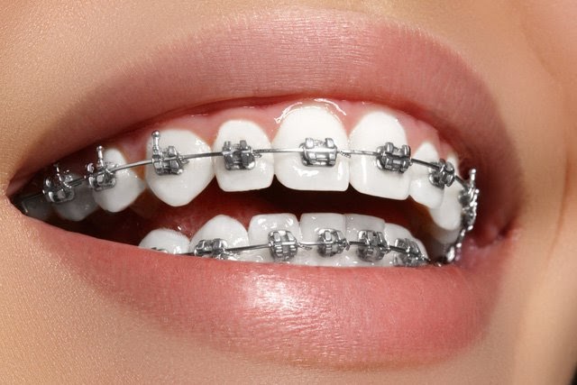 Niềng răng mắc cài là một phương pháp chỉnh hình răng rất phổ biến