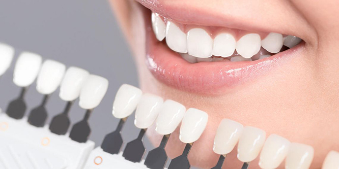 Dán sứ veneer là gì? 