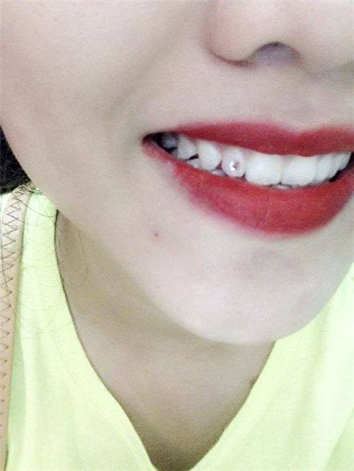 Hướng dẫn cách đính đá lên răng tại nhà 