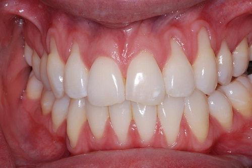 Răng bị tụt lợi