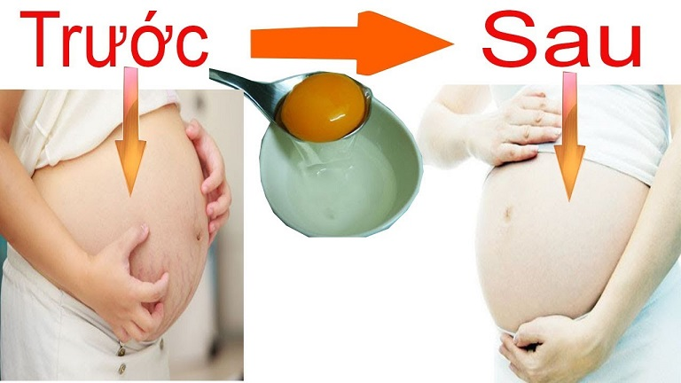 Giảm rạn bụng sau sinh bằng trứng gà
