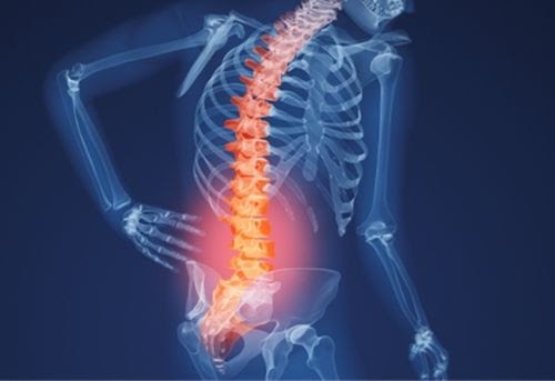 Thoái hóa cột sống