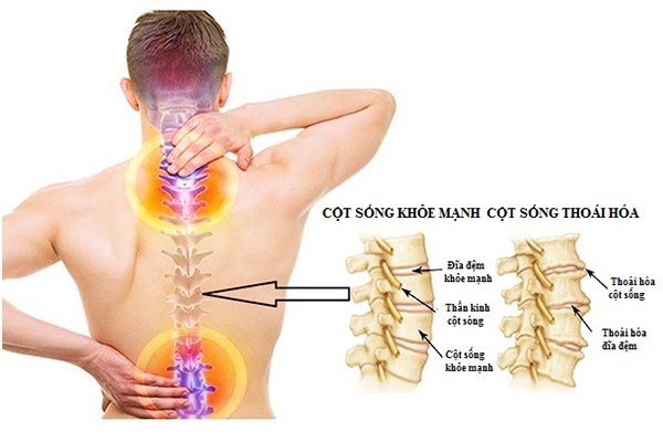 Cột sống khỏe mạnh và cột sống thoái hóa