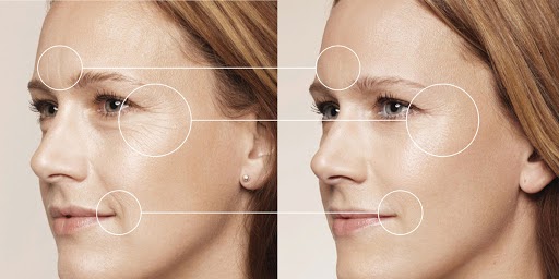 Nguyên nhân khiến xuất hiện nếp nhăn trên mặt là gì?