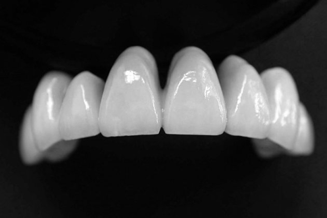 So sánh răng sứ cercon và ceramill về độ an toàn 