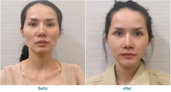 Như thế nào là má hóp?