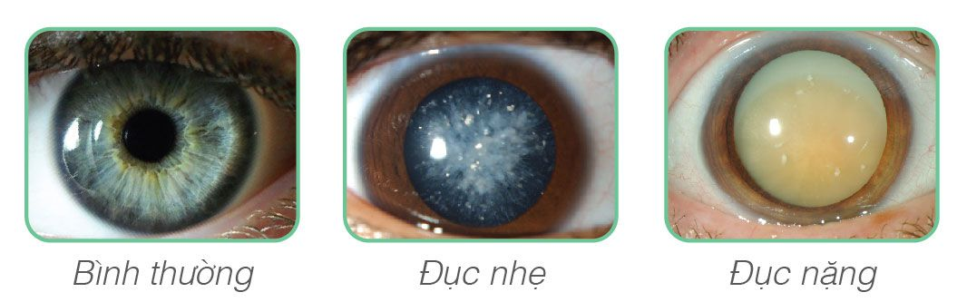 Đục thuỷ tinh thể làm thị giác của bạn giảm, mờ ,nhoè