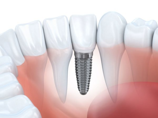 Phương pháp trồng răng cửa Implant