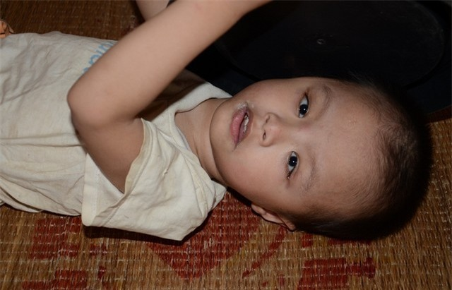 Bệnh đục thuỷ tinh thể bẩm sinh có thể gây ra tình trạng lác mắt cho trẻ