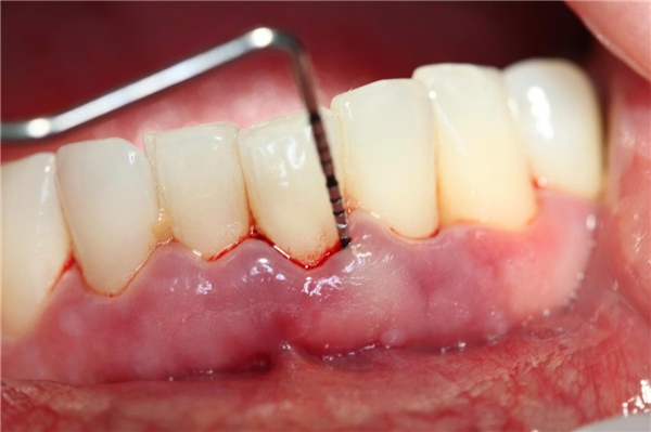 Nếu cao răng ăn sâu gần nướu thì phải chờ nướu liền lại mới tẩy trắng được