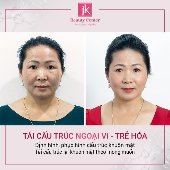 Huyệt thái dương đầy đặn lên trông thấy khi áp dụng phương pháp tái cấu trúc ngoại vi - trẻ hóa