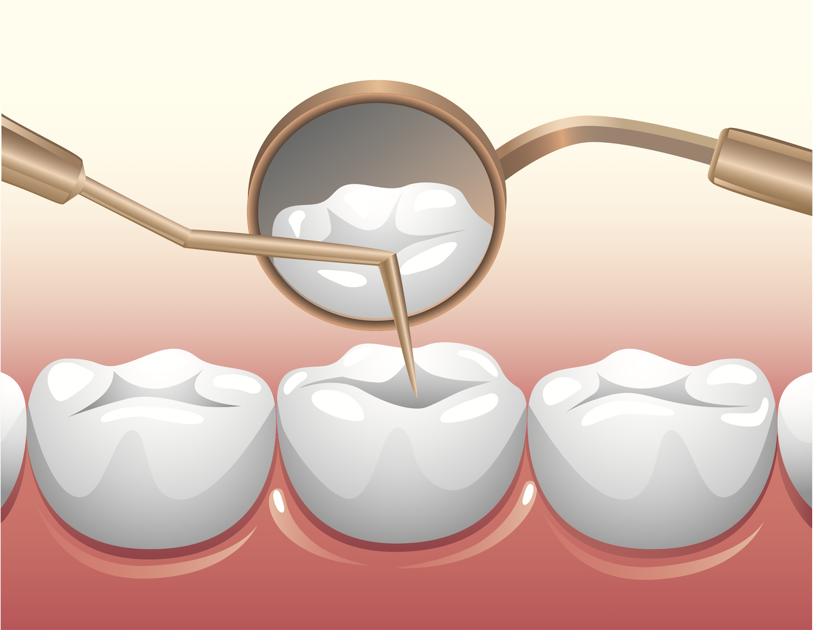 Chọn chữa tủy răng thay vì nhổ để bảo toàn răng tự nhiên