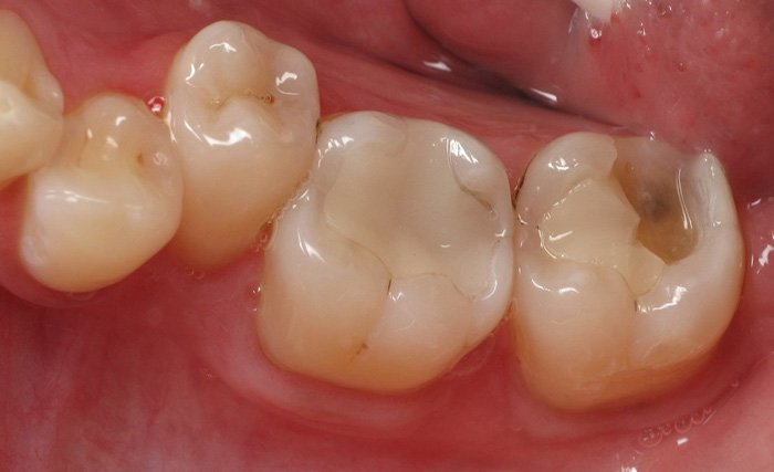 Ưu điểm của loại vật liệu trám răng Composite 