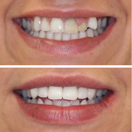 Bọc răng sứ một vài chiếc răng