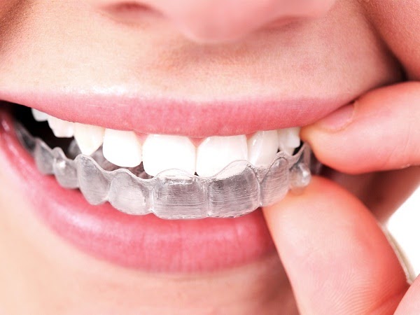 Niềng răng tháo lắp vô cùng tiện lợi cho khách hàng 