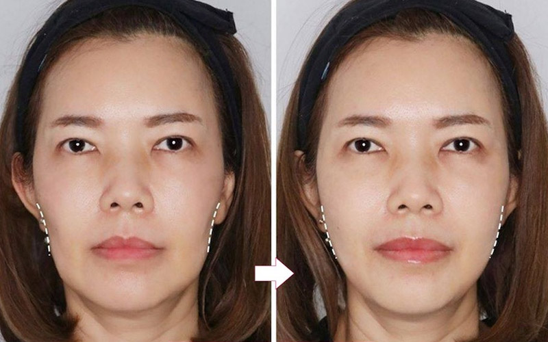 Kết quả sau khi tiêm má baby