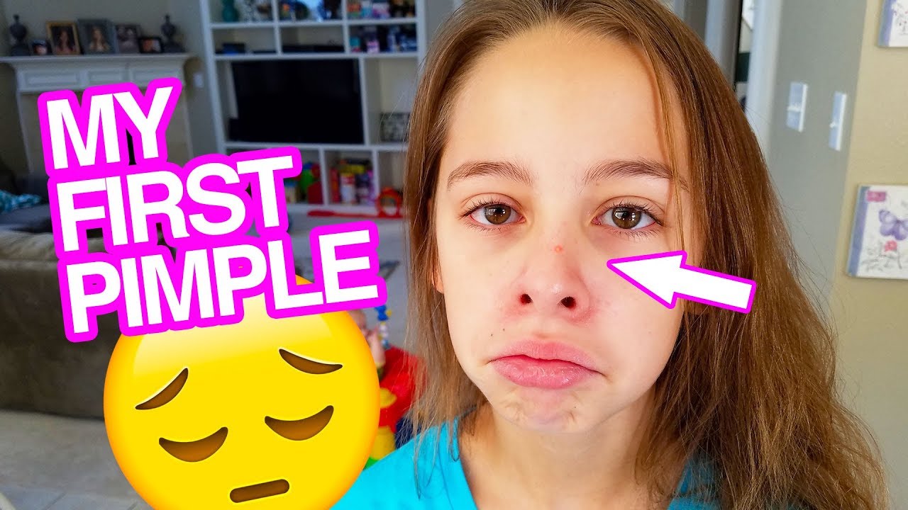 How Long Does Puberty Acne Last? (What is Teenage Acne) How Long Does Puberty Acne Last? (What is Teenage Acne)