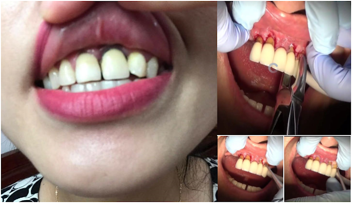 Những hậu quả răng bị tụt lợi